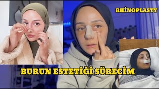 BURUN AMELİYATI SÜRECİM  VLOG [upl. by Etireuqram711]