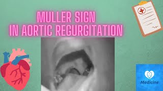 müller sign Aortic regurgitation  muller sign medicine physical examination [upl. by Nawd786]