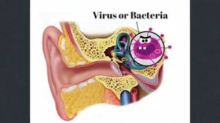 Labyrinthitis [upl. by Tosch]