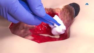 How to Effectively Cleanse and Debride a Wound  Wound Cleansing and Debridement  Ausmed Education [upl. by Eamaj689]