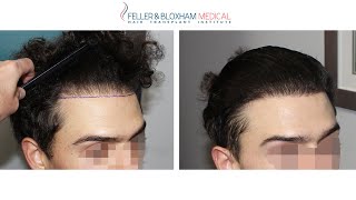 FUE Hair Transplant Gone Wrong Can it be Fixed  Dr Bloxham  Feller amp Bloxham NY NYC LI [upl. by Othelia]