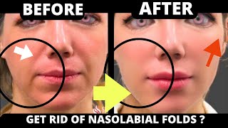 🛑 HOW TO GET RID OF NASOLABIAL FOLDS WIITH FACE YOGA  JOWLS SAGGY SKIN FOREHEAD  FACIAL MUSCLES [upl. by Pollyanna123]