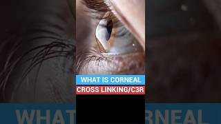 Corneal cross linking C3R  Keratoconus Treatment Cost [upl. by Teeniv]