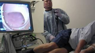 Colonoscopy  Stop pulling method  passing B [upl. by Marte]