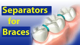 Separators Spacers for Braces  Braces Guide [upl. by Helga]