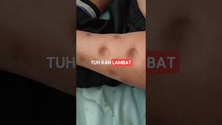 Pitting edema adalah pembengkakan pada bagian tubuh tertentu [upl. by Llehcnom]