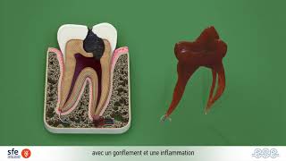 Endodontic Treatments  French version [upl. by Anrim456]