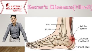 Severs Disease Hindi [upl. by Nuahsal241]