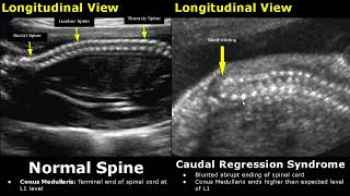 Fetal Spine Ultrasound Normal Vs Abnormal Image Appearances  Spinal Abnormalities  Obstetric USG [upl. by Novy]