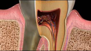 Abscess Combined Lesion [upl. by Nennek]