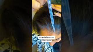 Sick and tired of hair loss Hair loss Hair growth Alopecia Haircare Trending [upl. by Acireed131]