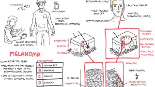 Melanoma  Overview signs and symptoms pathology risk factors treatment [upl. by Gallenz]