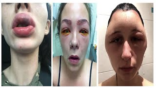 Cosmetic Allergic Reaction Gone Wrong [upl. by Knowles406]