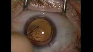 Echange implant intra oculaire  Intra ocular lens exchange [upl. by Ahsemak]