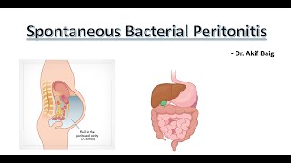 Spontaneous Bacterial Peritonitis  Dr Akif Baig [upl. by Sancha]