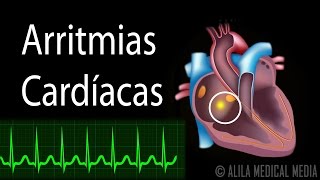 Arritmias Cardíacas Animación Alila Medical Media Español [upl. by Olivette]