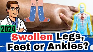 1 Cause of Swollen Ankles Legs or Feet What Causes It Dangers [upl. by Airda]