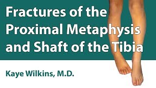 Fractures Of The Proximal Metaphysis amp Shaft Of The Tibia [upl. by Erastatus506]