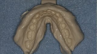 Accurate and Easy Alginate Impressions and Stone Casts [upl. by Pepin437]