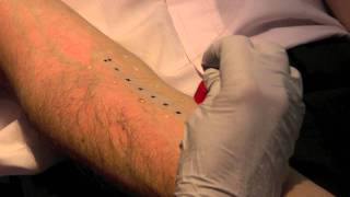 Skin Prick Allergy Test [upl. by Aizat805]