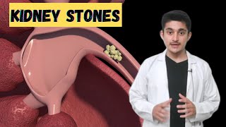 Kidney stones Renal calculi 3d animation  symptoms pain types treatment  how are they formed [upl. by Zusman]