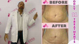 Liposuction Fibrosis Treatment Soften and Smooth Lumps and Bumps [upl. by Edmondo]