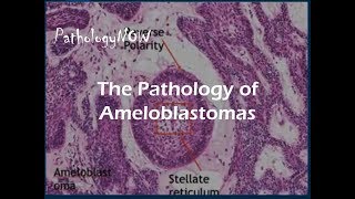 The Pathology of Ameloblastomas [upl. by Spiegel]