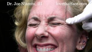 Botox Browlift by Dr Joe Niamtu III [upl. by Asamot]