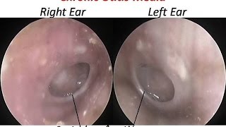 Endoscopy of Ears with perforation Chronic Otitis Media  Result of Allergy  Recurrent Cold amp PND [upl. by Tanhya749]