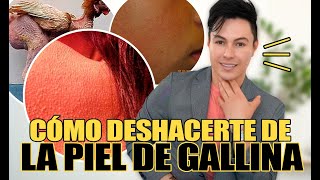 ¿Cómo Quitar La Piel de Gallina Queratosis Pilaris [upl. by Doig243]