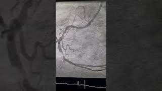 inf MI  coronary angiography and PCI [upl. by Joli306]