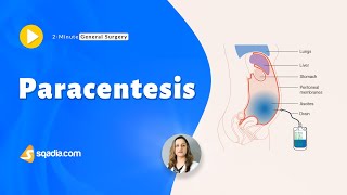 Paracentesis  General Surgery Video  Medical Education  VLearning™  sqadiacom [upl. by Bekah]