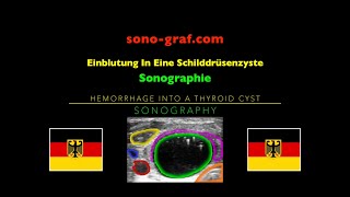 Sonographie  Einblutung In Eine Schilddrüsenzyste [upl. by Yasmar78]