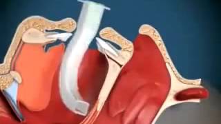 Técnica de Colocação da Cânula Orofaríngea [upl. by Andrei]