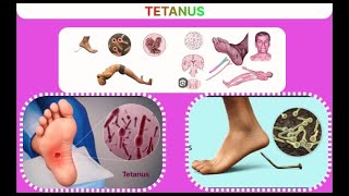 Tetanus  تشنج  धनुस्तंभ [upl. by Lambrecht682]