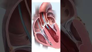 हार्ट के वाल्व को कैसे ठीक करते है  Repair Heart Valve in 3D Animation  Easy StepbyStep Guide [upl. by Sackville]