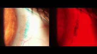 11 Slit Lamp Techniques Lissamine Green HD [upl. by Patrica]