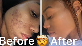 Skin Care Journey How I cleared my skin Do’s and DONT’s Epiduo Forte review [upl. by Chisholm784]