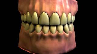 Dental Bruxism Teeth Grinding [upl. by Sessler]