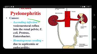 Pyelonephritis Acute Chronicpart 1 [upl. by Anirtep]