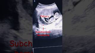 Subchorionic Hematomasubchorionic hemorrhage  1st trimester ultrasound ytshorts baby pregnancy [upl. by Bbor]