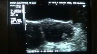 Bilateral ovarian cysts ultrasound study [upl. by Eciralc]