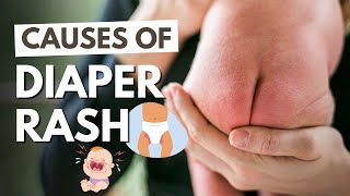 Baby Has DIAPER RASH This Is What Caused It Home Remedies Included [upl. by Ursala]