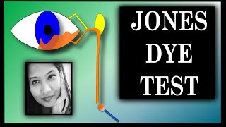 Jones Dye Test  1 amp 2  Lacrimal Drainage Disorders  Oculoplasty [upl. by Estus]