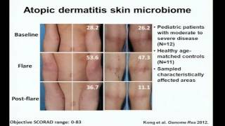 Eczema Immunity and the Skin Microbiome  Heidi Kong [upl. by Etheline]