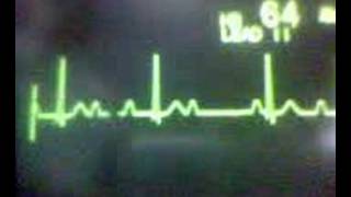 ECG Video AV Block  Second Degree Type 1 Wenckebach [upl. by Carree]