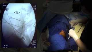 WATCH a Cervical Radiofrequency Ablation  LIVE [upl. by Iinde286]