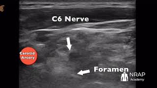 Ultrasound Guided C6 Nerve Injection [upl. by Ablem894]