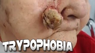 Cysts Blackheads Skin amp Trypophobia [upl. by Noyerb]