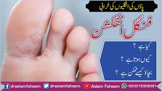 How to Get Rid of Fungal Infection of Feet Athletes Foot HindiUrdu  Fungal Infection Home Remedy [upl. by Nanni837]